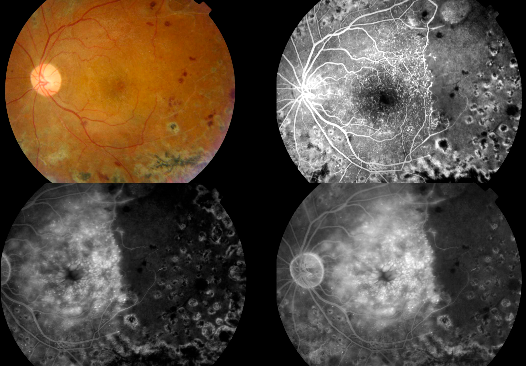 Diabetic Retinopathy