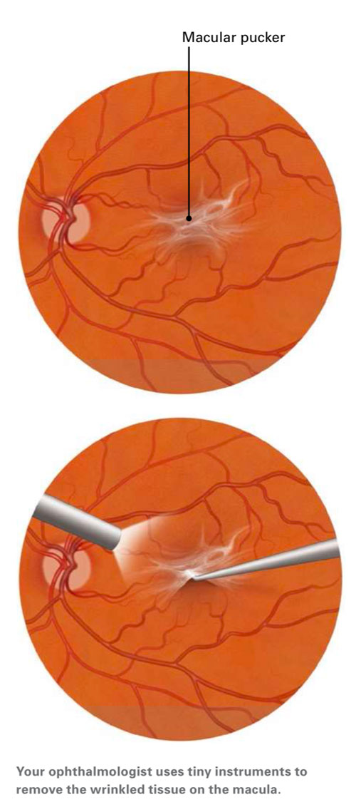 Macula surgery